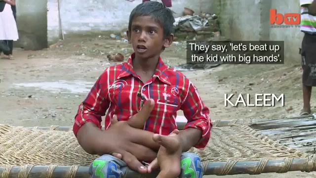 دستهای غول پیکر پسر هندی !!