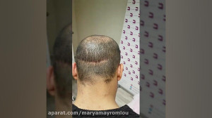 ظاهر نامناسب بخیه کاشت مو و رف...
