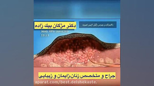 درمان زگیل تناسلی چگونه است؟