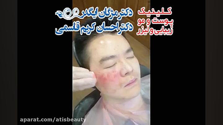 میکرونیدلینگ طبیعی ترین روش جو...