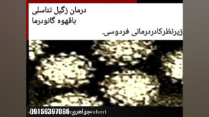 درمان زگیل تناسلی