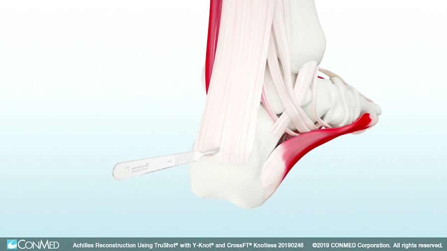 Achilles Reconstruction Using TruShot® and CrossFT® Knotless