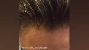 پروتز مو ترمیم مو