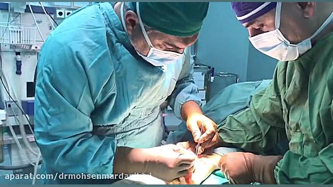 جراحی سندرم تونل کارپال