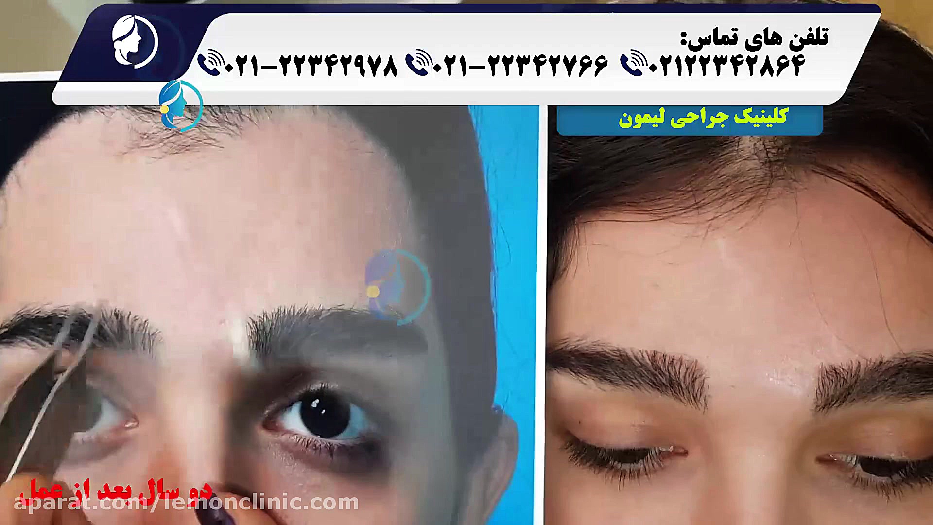 ترمیم جای زخم اسکار توسط کلینی...