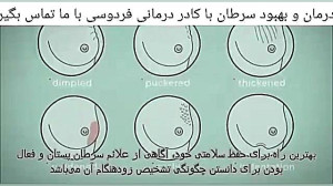 سرطان سینه و درمان