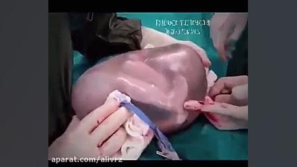 جنین با کیسه آب از شکم مادر خا...