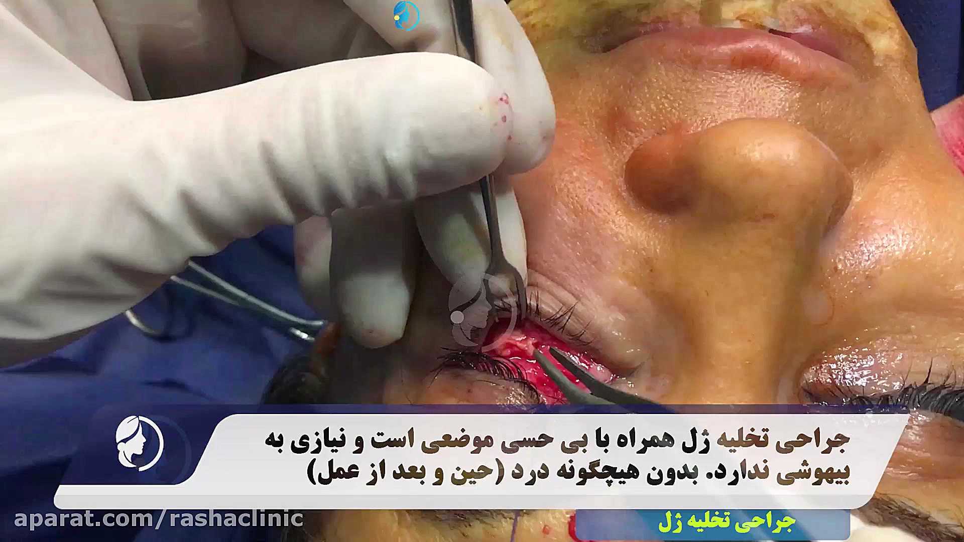 تخلیه ژل توسط مرکز جراحی لیمون