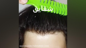 کاشت و ترمیم موی شقایق