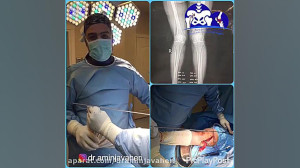جراحی استئوتومی زانوی ضربدری