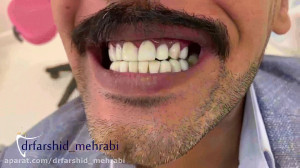 فیلم کامپوزیت دندان، کامپوزیت...