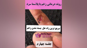ترمیم زخم بدون درد با دستگاه پ...