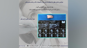 نمونه جراحی دندان عقل بدون درد...