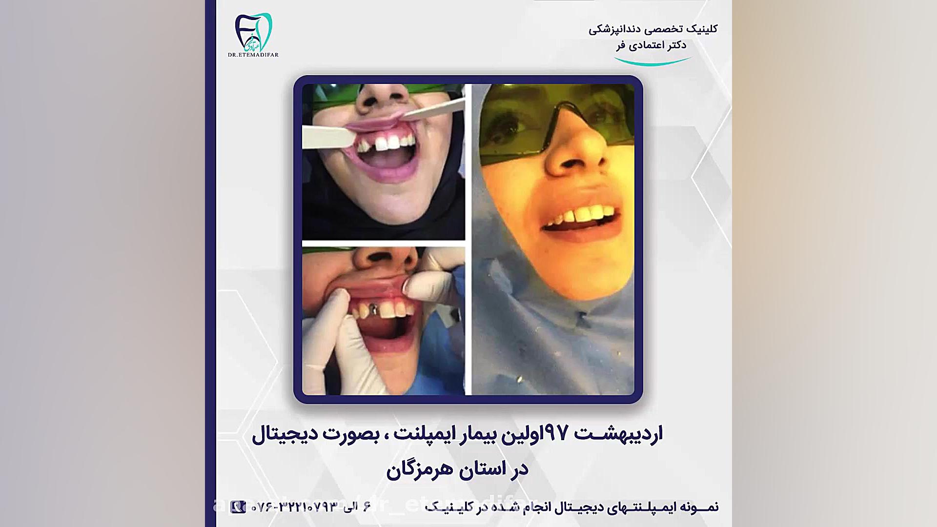 ایمپلنت دیجیتال دکتر اعتمادی ف...