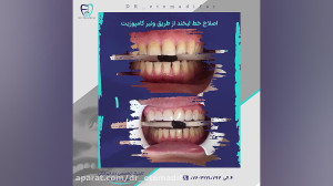 نمونه ونیرکامپوزیت توسط دکتر ا...