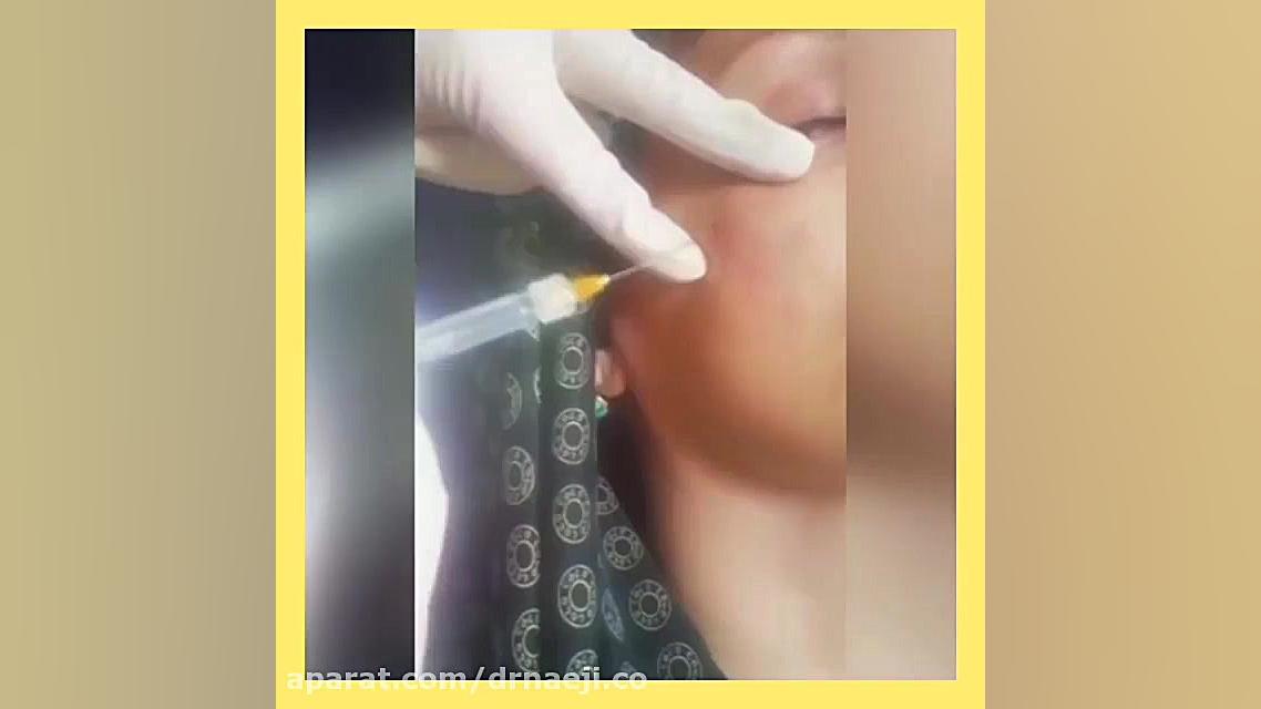 از بین بردن گودی زیر چشم با تز...