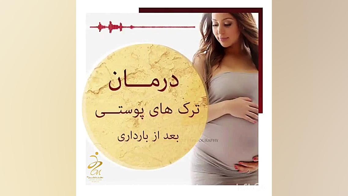 درمان ترک های پوستی بعد از بار...