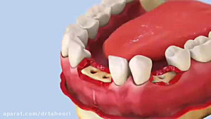 ایمپلنت دندان مرکز دندانپزشکی...