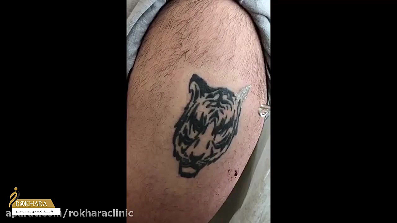 پا کردن تتو و خالکوبی