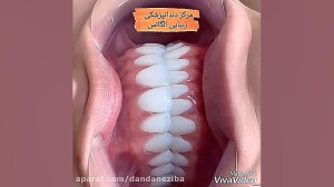 بهترین مارک کامپوزیت دندان | م...