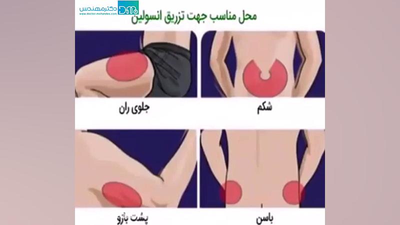 آموزش تزریق انسولین