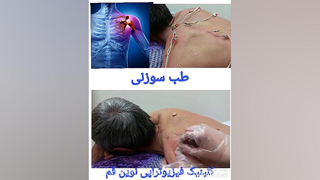 طب سوزنی برای درمان شانه یخ زد...