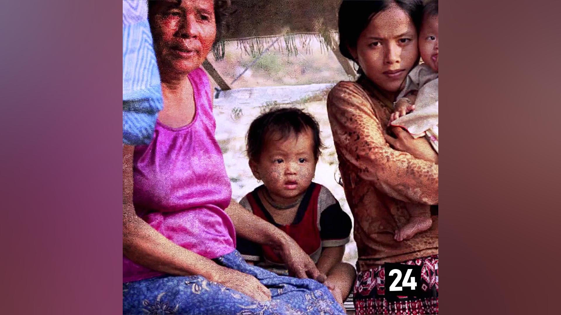 گرسنگی پنهان کودکان