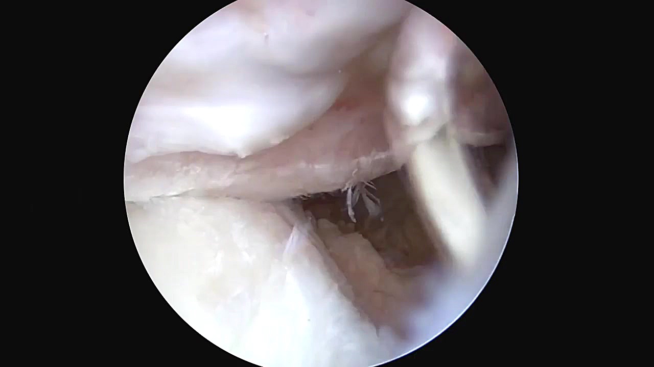 Dr. Buford  Remplissage, Banka...