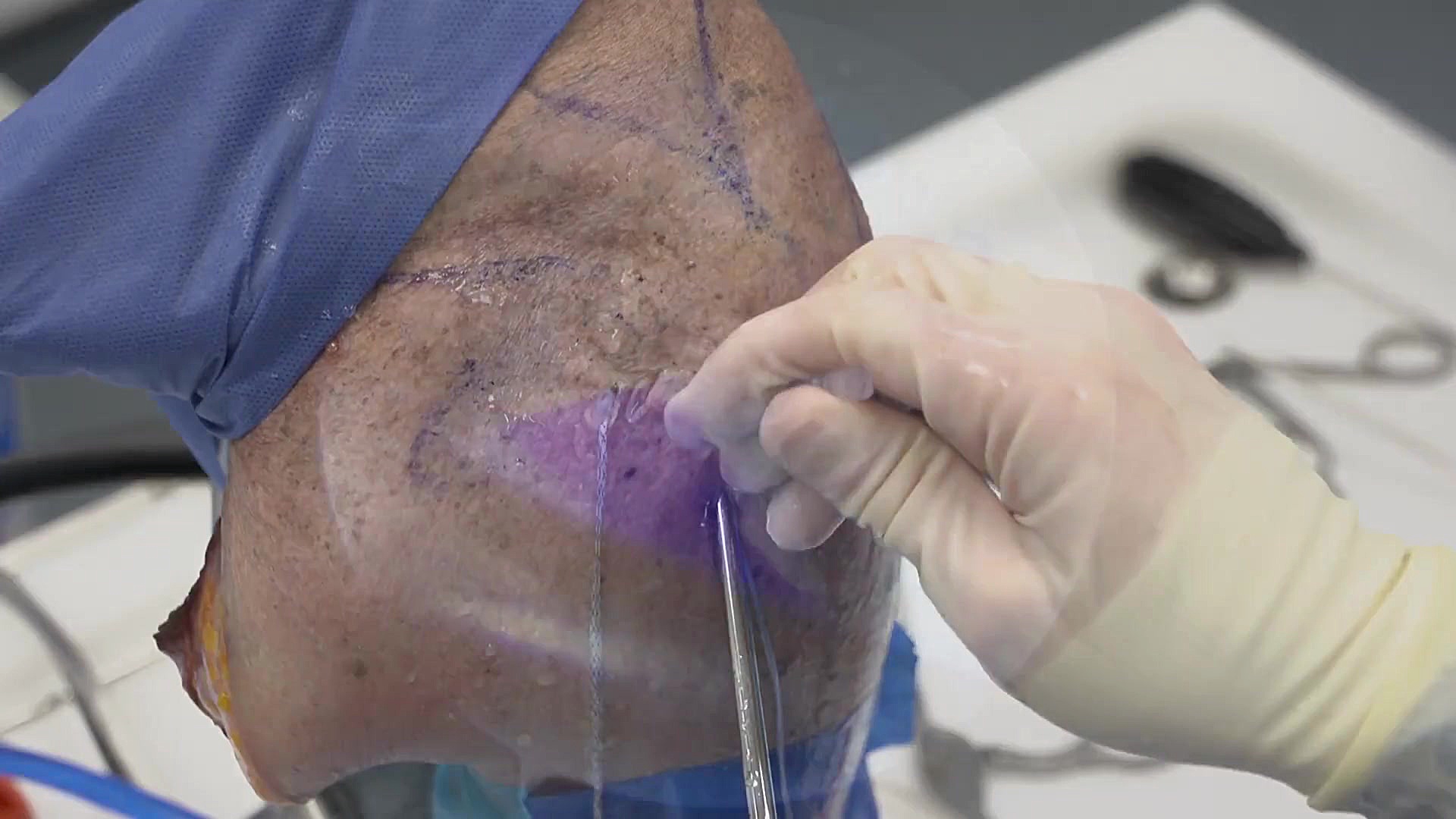 Dr. Solic  SCR Using Y Knot&re...