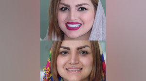 اصلاح خط لبخند کامپوزیت ونیر