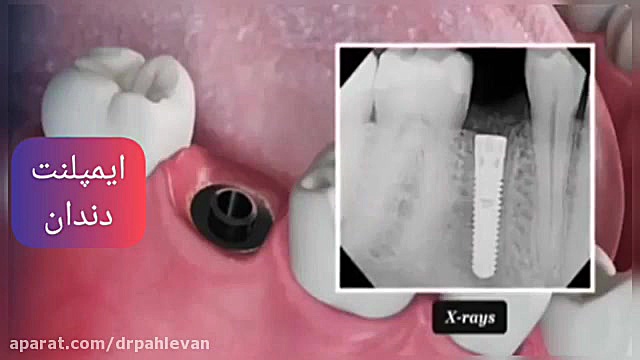 ایمپلنت دندان جلو