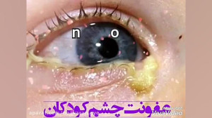 عفونت چشم کودکان