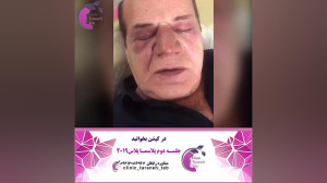 پلاسما جت پلک و بینی