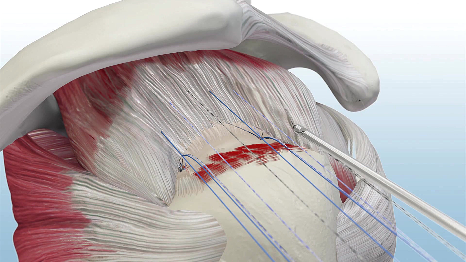 Single Row Rotator Cuff Augmentation Using GENESYS CrossFT®, Allopatch HD