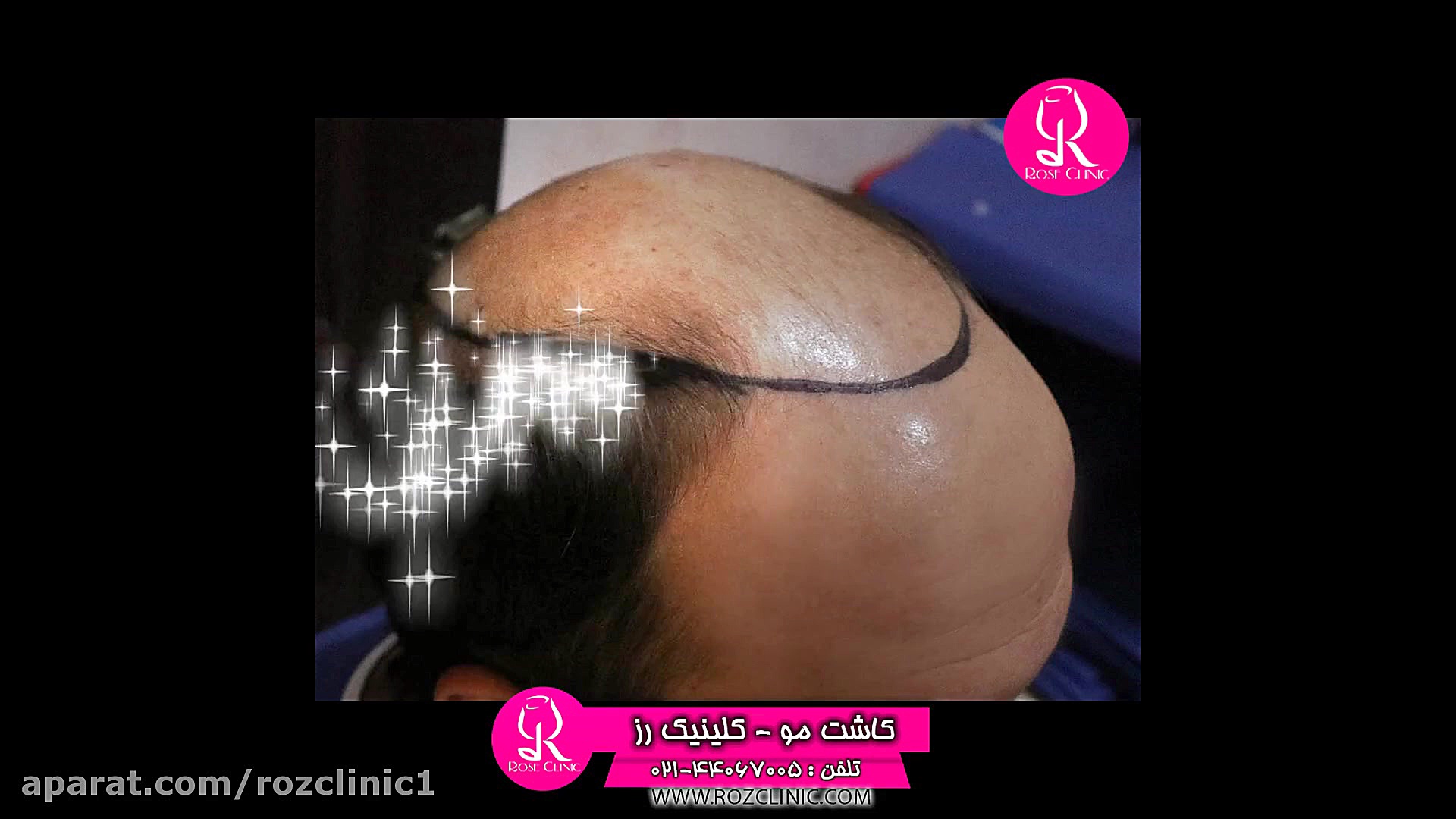 کاشت مو | فیلم کاشت مو | کلینی...