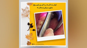 لیفت لثه با لیزر دکتر اعتمادی...