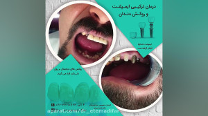 درمان ترکیبی ایمپلنت و روکش دن...