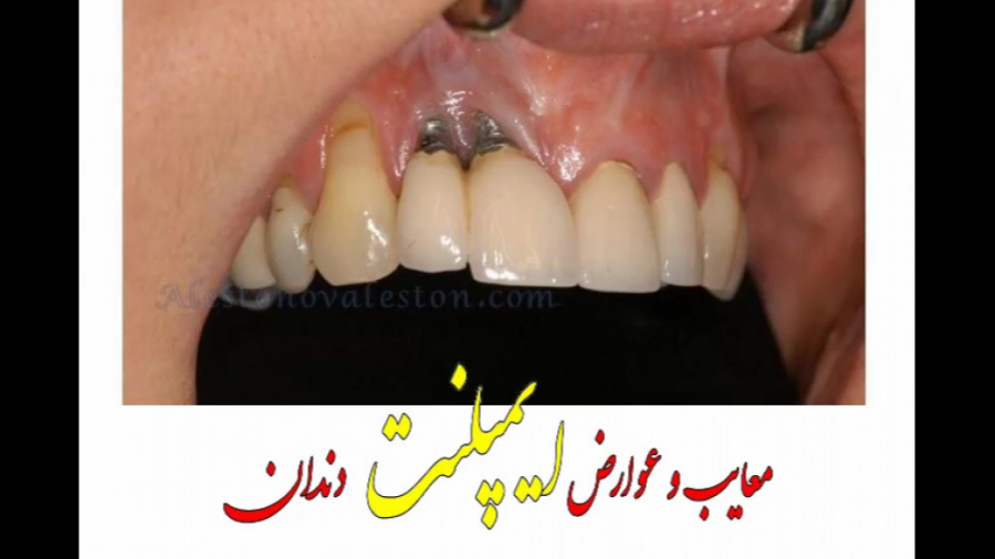 معایب و عوارض ایمپلنت دندان