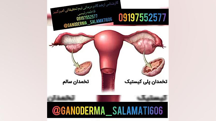 پلی کیستیک تخمدان یا تنبلی تخم...