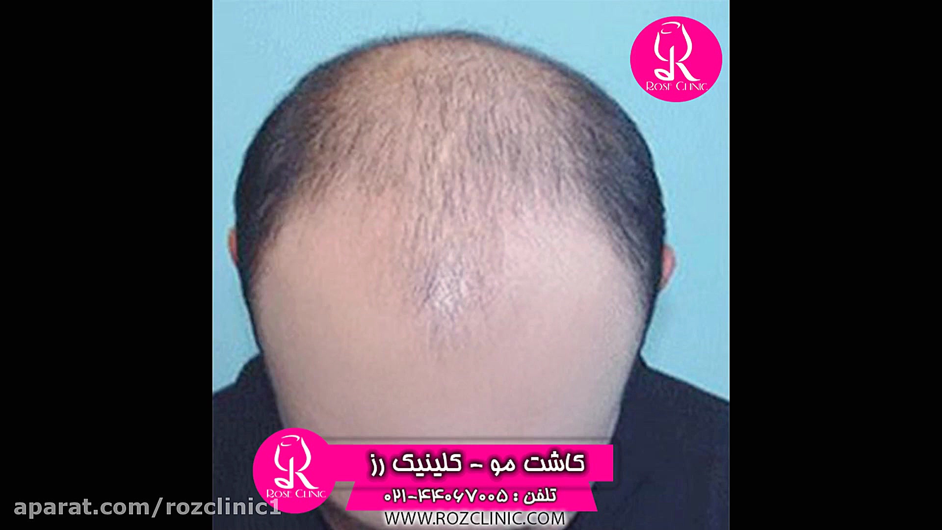 کاشت مو | فیلم کاشت مو | کلینی...