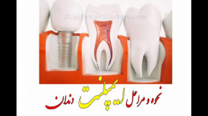 نحوه و مراحل ایمپلنت دندان