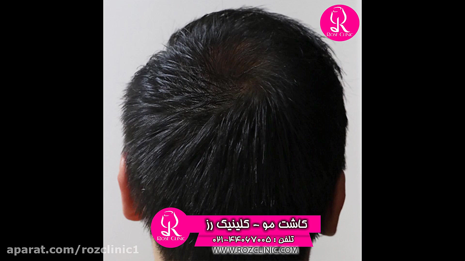 کاشت مو | فیلم کاشت مو | کلینی...