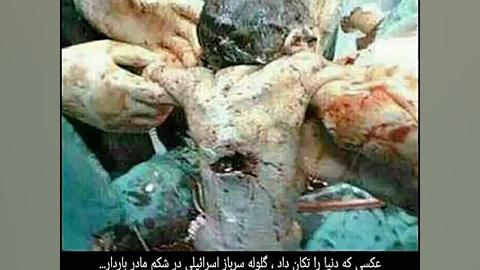 گلوله سرباز اسرائیلی در شکم ما...