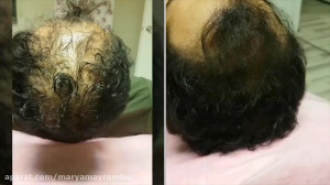 روش قطعى رفع طاسى و كمپشتى موى...