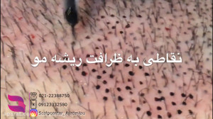 كاشت مو كردى از تراكم موهات نا...