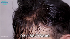 ترمیم مو با استفاده از پروتز م...