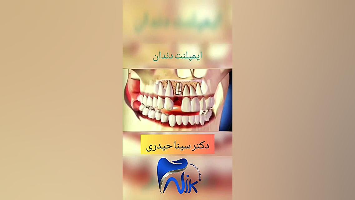 فیلم ایمپلنت دندان