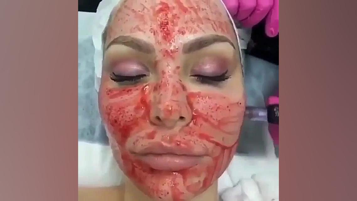 میکرونیدلینگ به همراه مواد مزو