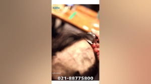 ترمیم مو مو | پروتز مو | ترمیم...