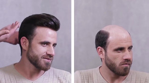 ترمیم مو موکاران | پروتز مو |...